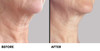 Tighten and firm skin in the chin and neck areas with this breakthrough anti-aging formula. 