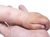 Association Between Eczema and Molluscum Contagiosum