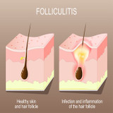 Proven Folliculitis Home Remedies for Fast Relief