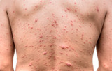 Large Acne and Pimple Infections