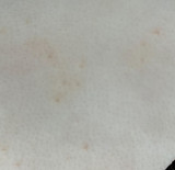 Appearance of Beginning Stage Molluscum