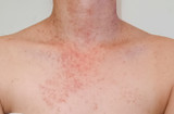 Bacterial Folliculitis Causes: Key Bacteria & Risk Factors