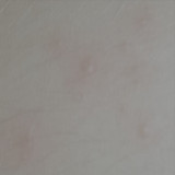 Molluscum Contagiosum vs Folliculitis