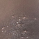It's Never Black and White: Racial and Ethnic Differences in Molluscum Contagiosum and Eczema