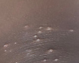 It's Never Black and White?: Racial and Ethnic Differences in Molluscum Contagiosum and Eczema
