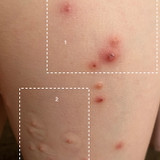 How to Stop Molluscum from Spreading using Mollenol