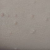 How Do I Know Which Mollenol Product to Order if I am Using it for Molluscum?