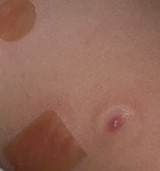 Introduction to Molluscum Contagiosum