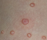 Names, Terms, and Spellings for Molluscum Contagiosum