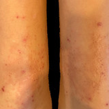 How Contagious is Molluscum?