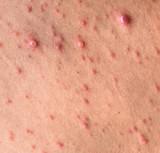 What Causes Pimples?