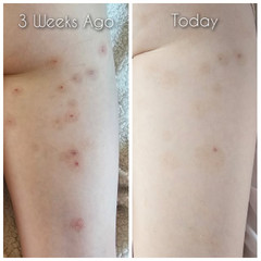 Before and After with Mollenol Before and After with Mollenol