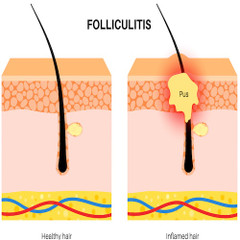 What Causes Folliculitis? Triggers, Risks & Prevention Tips What Causes Folliculitis? Triggers, Risks & Prevention Tips