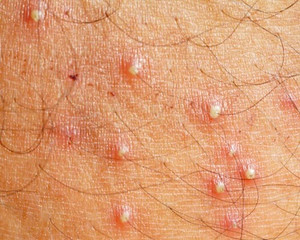 Understanding Folliculitis and Mollenol Understanding Folliculitis and Mollenol