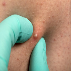 What Does Folliculitis Look Like? Photos, Signs, Vs. Acne What Does Folliculitis Look Like? Photos, Signs, Vs. Acne