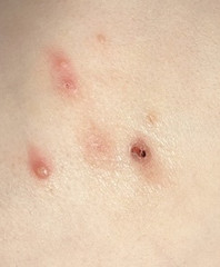 How to Get Rid of Molluscum: Medical & Home Treatments How to Get Rid of Molluscum: Medical & Home Treatments
