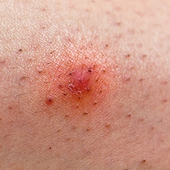 How to Treat Ingrown Hair: At-Home Steps & When to Get Help How to Treat Ingrown Hair: At-Home Steps & When to Get Help