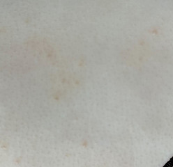 Appearance of Beginning Stage Molluscum