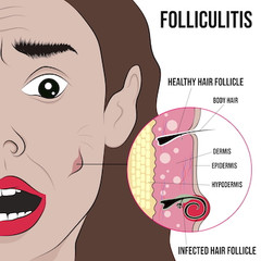 Folliculitis Home Remedies for Fast Relief Folliculitis Home Remedies for Fast Relief