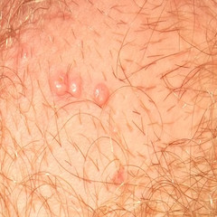How to Treat Bumps Under Hair