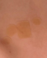 How to Apply Mollenol and Patches: Step-by-Step Guidance How to Apply Mollenol and Patches: Step-by-Step Guidance