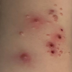 Molluscum Inflammation: Understanding Good vs. Bad Signs Molluscum Inflammation: Understanding Good vs. Bad Signs