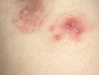 About Molluscum: What is molluscum contagiosum? About Molluscum: What is molluscum contagiosum?