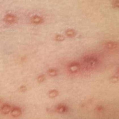 Large, Pus-filled Molluscum Results in Widespread Infection