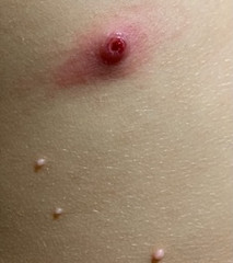 Can molluscum bumps inflame? Can molluscum bumps inflame?