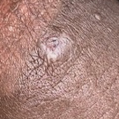 Mollenol and Adult Molluscum Contagiosum Mollenol and Adult Molluscum Contagiosum
