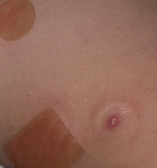 Introduction to Molluscum Contagiosum