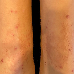 How Contagious is Molluscum?