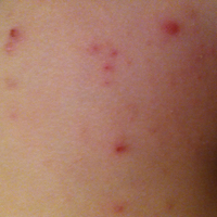 molluscum-contagiosum-treatment-scratched Mollenol remedy for skin eruptions