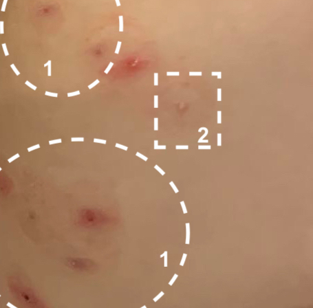 Do not apply Mollenol to open molluscum as it may sting. mollenol-dont-apply