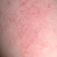 Hives or BOTE sign in Molluscum? Beginning of the end of with hive like rash