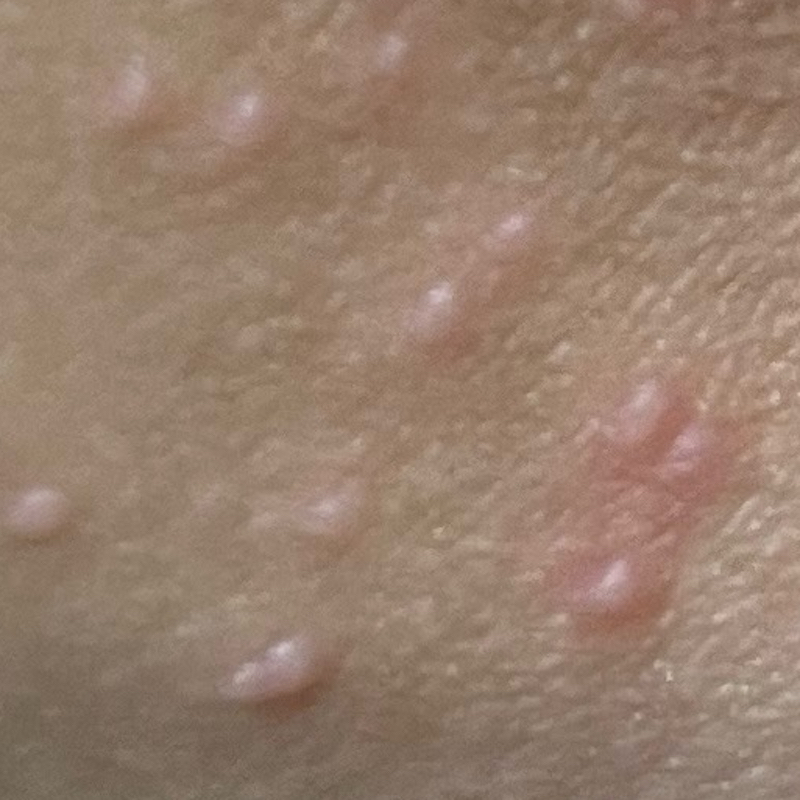 Developing molluscum Mollenol treatment Remedy for minor skin eruptions