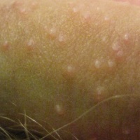 Remedy for molluscum contagiosum on penis shaft Treatment with Mollenol Sensitive