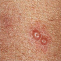 molluscum-contagiosum-treatment-with-mollenol.jpg Treatment with Mollenol