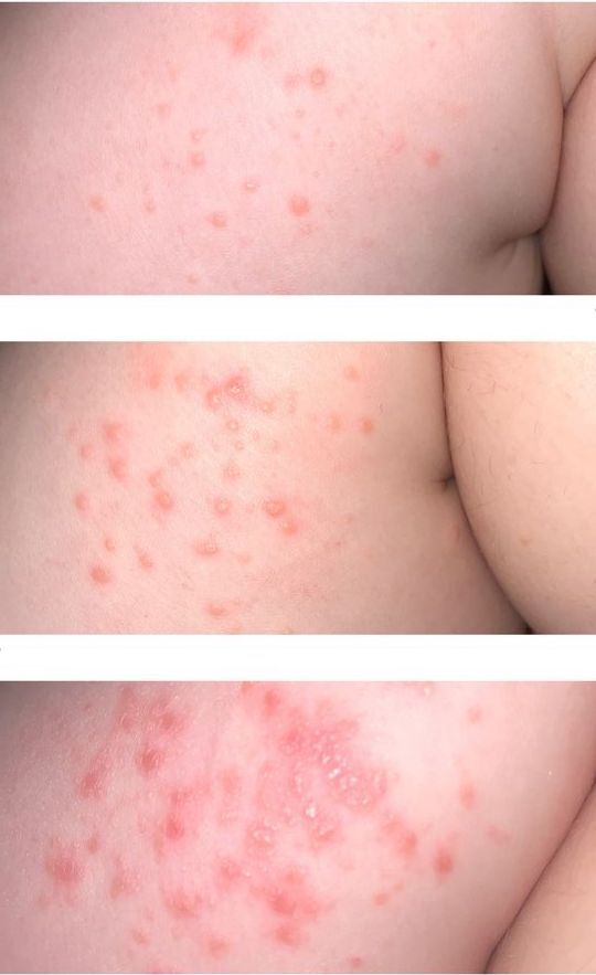 Mollenol Review before and after extensive molluscum contagiosum infection Mollenol review - before and after with Mollenol
