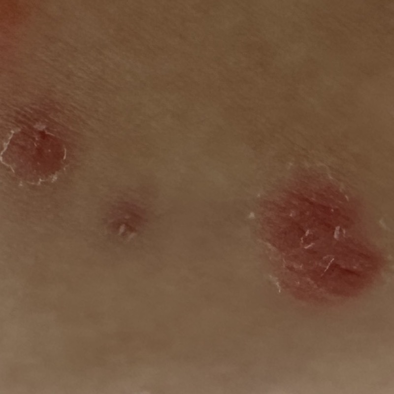 Open lesion. Stop applying Mollenol. Mollenol may sting or burn. 