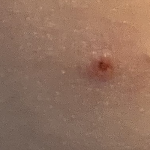 Dont apply Mollenol to healing lesion