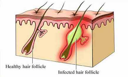 Mollenol for folliculitis