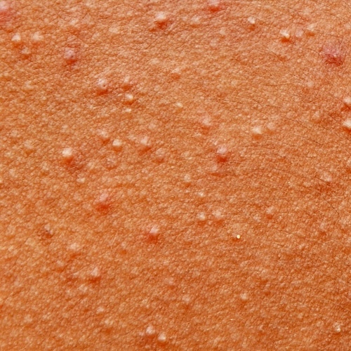 Bumps and skin eruptions developing and growing