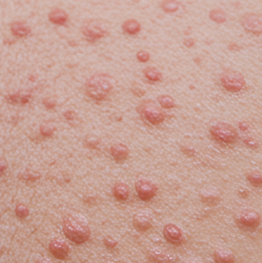 Mollenol for minor skin eruptions