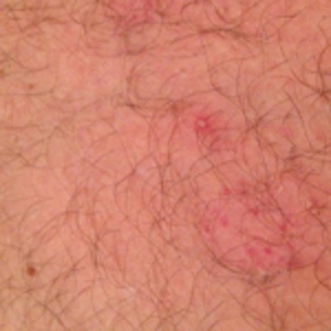 Molluscum inflammation has reduced and small beginning bumps are scabbing over. Mollenol applied and an adhesive bandage used to stop spread of molluscum contagiosum virus.