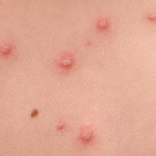 Mollenol for minor skin eruptions