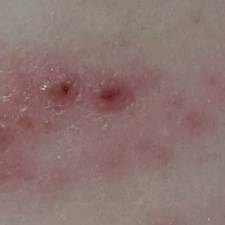 Bumps have reduced in size and it is now time to stop using Mollenol Patches