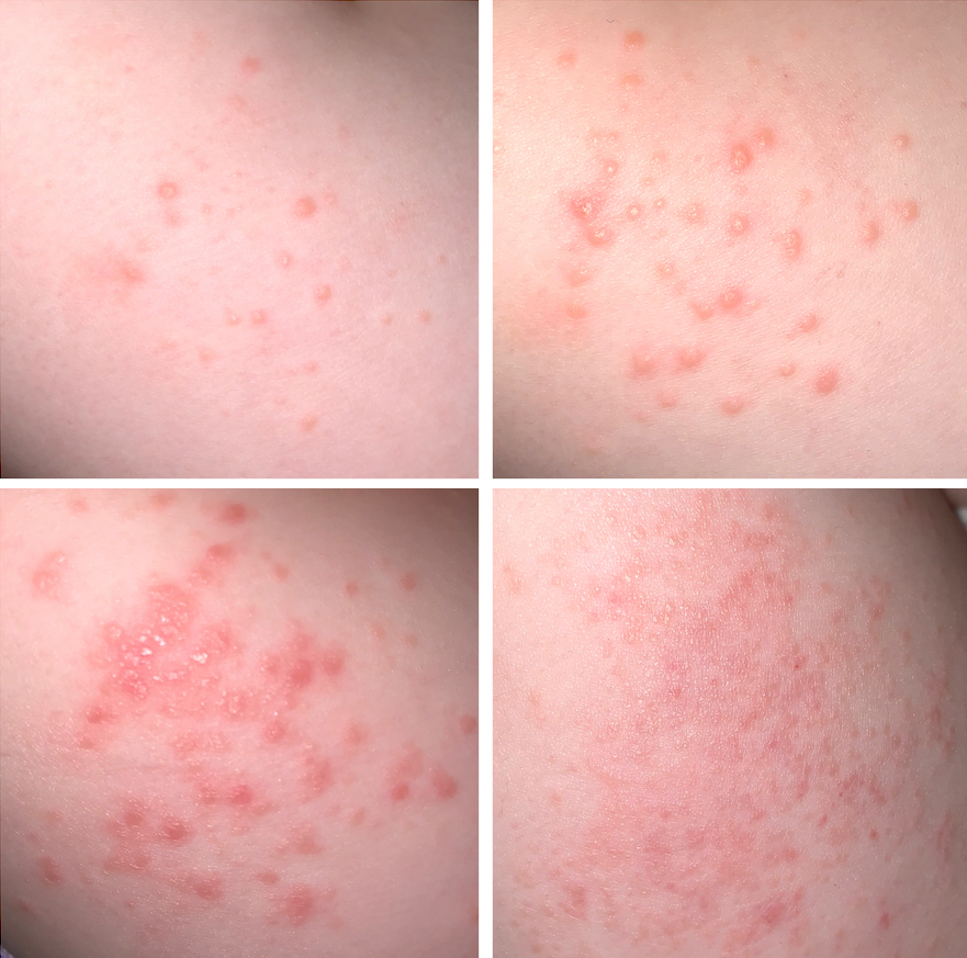 Stages of healing - Mollenol