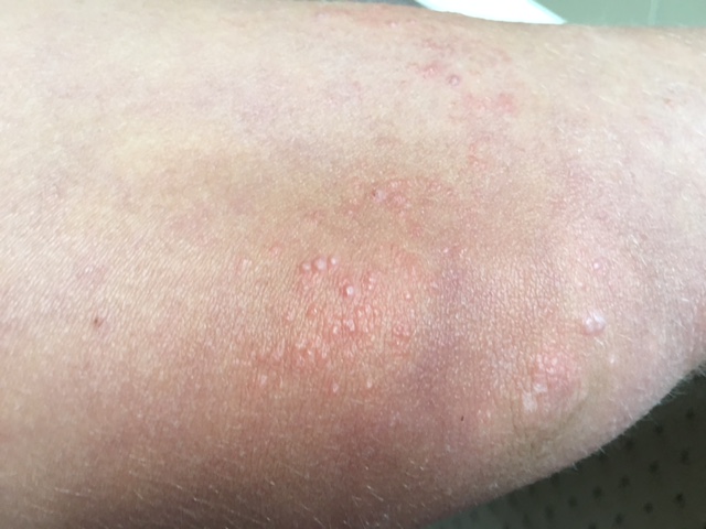 Thigh Infection Mollenol For Molluscum Contagiosum