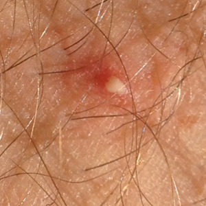 Large highly contagious pus filled molluscum bump before treatment with Mollenol.